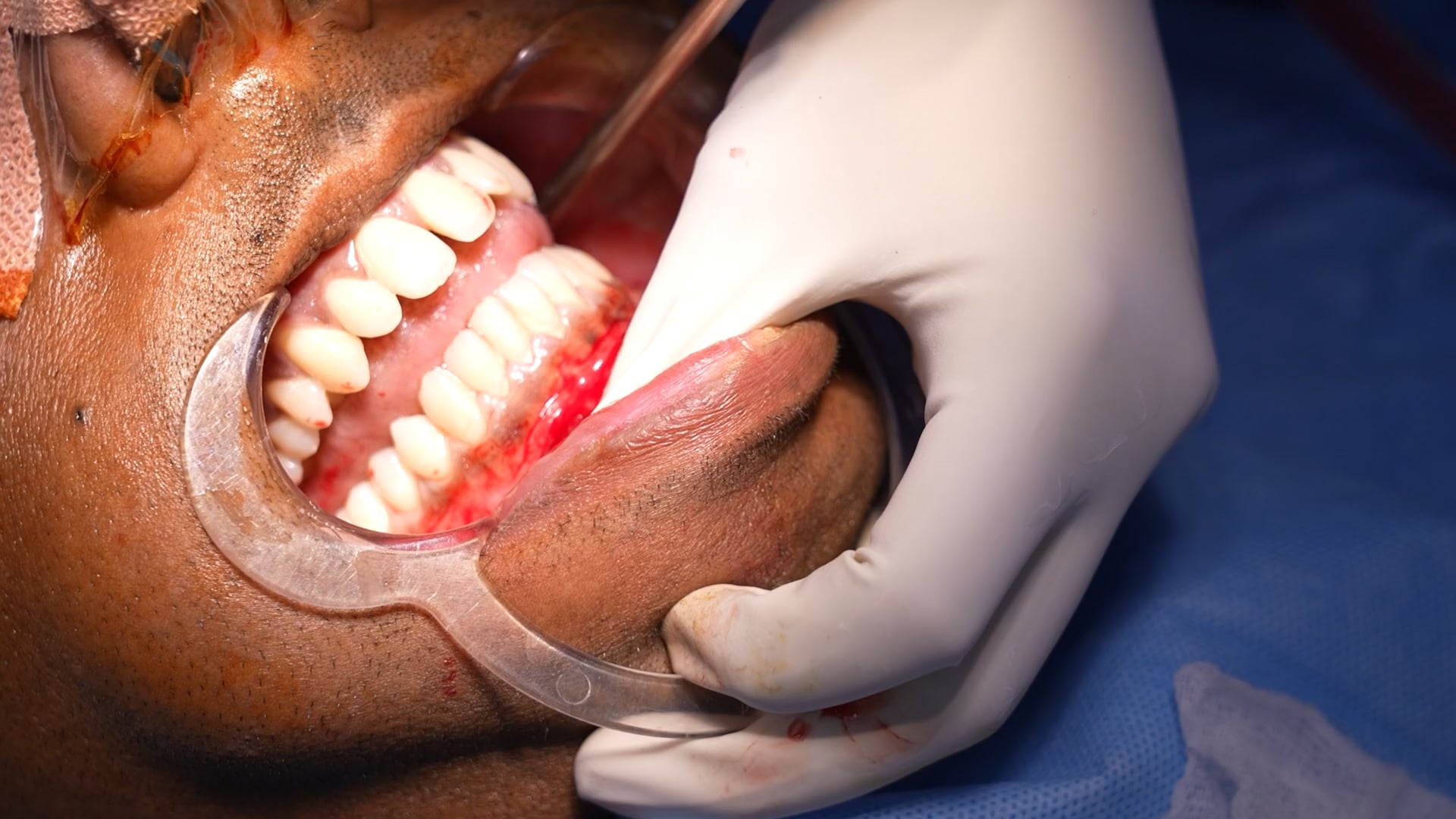 Jaw Surgery short